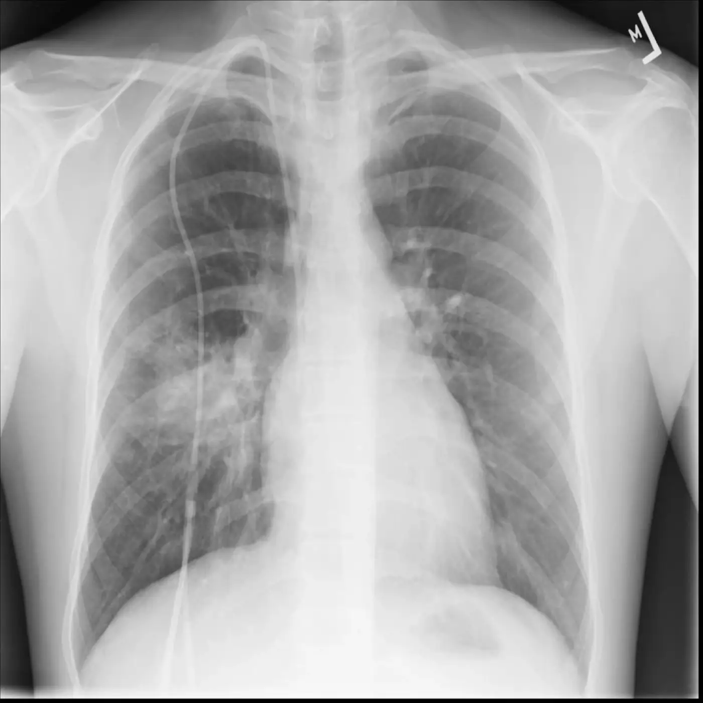 Real frontal chest X-ray published on Qurmi